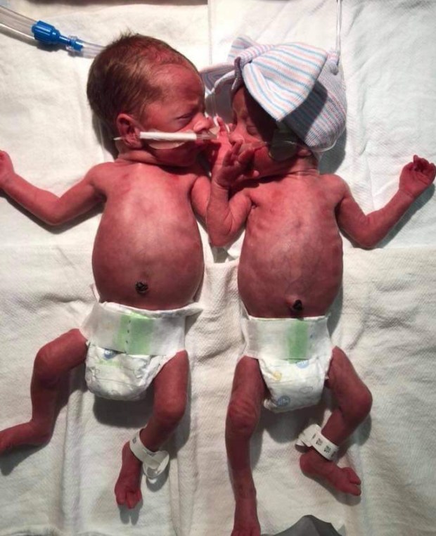 Singleton Twins as infants #EncoreRehab Cullman